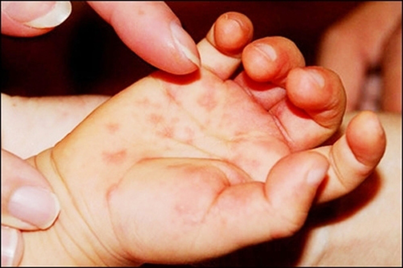 Muốn con kh&ocirc;ng mắc ch&acirc;n tay miệng cần l&agrave;m ngay những điều n&agrave;y