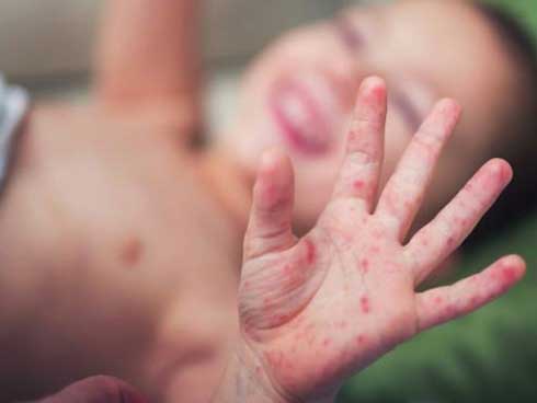Bệnh ch&acirc;n tay miệng l&acirc;y lan ch&oacute;ng mặt: C&aacute;c dấu hiệu nhận biết sớm nhất