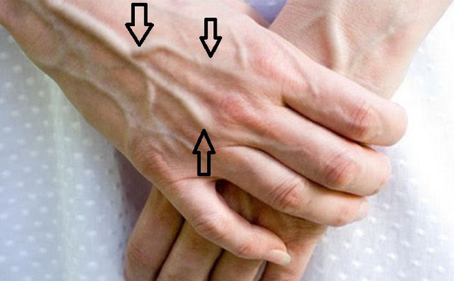 Nổi g&acirc;n xanh: Đừng coi thường bởi đ&oacute; c&oacute; thể l&agrave; căn bệnh nguy hiểm chết người n&agrave;y