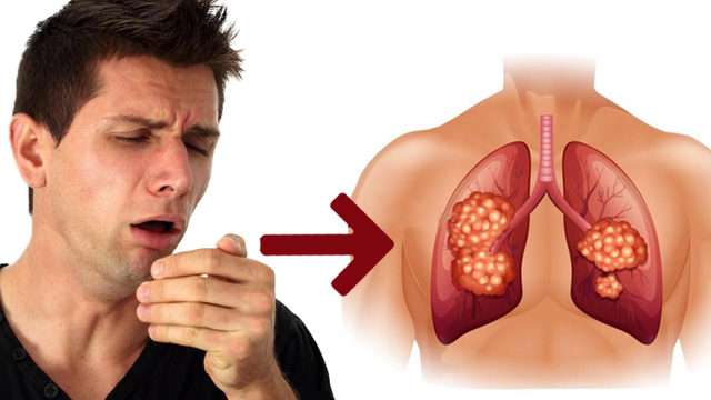 Ung thư phổi: Những dấu hiệu mắc bệnh nhiều người chủ quan