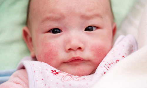 3 bệnh về da thường gặp nhất v&agrave;o m&ugrave;a đ&ocirc;ng v&agrave; c&aacute;ch ph&ograve;ng tr&aacute;nh
