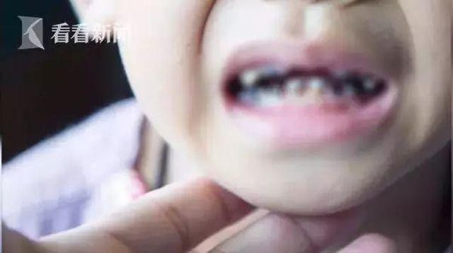 B&eacute; 3 tuổi bị mủn n&aacute;t 16 chiếc răng v&igrave; th&oacute;i quen nhiều cha mẹ Việt mắc phải