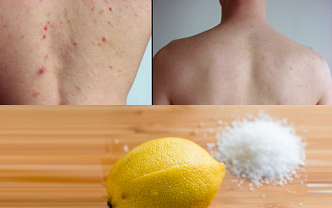 C&aacute;ch trị mụn trứng c&aacute; ở lưng, ngực đơn giản v&agrave; hiệu quả nhất
