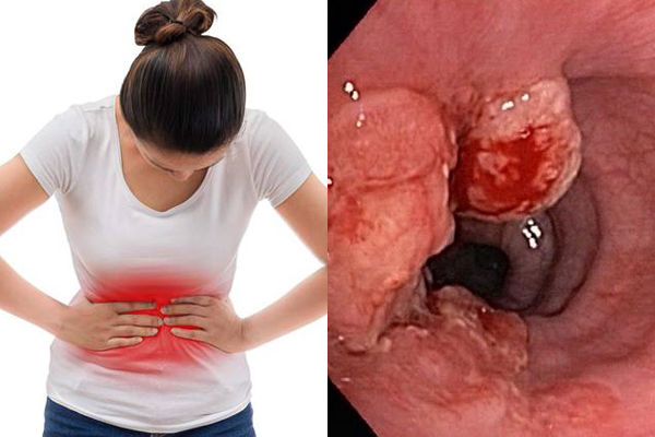C&ocirc; g&aacute;i 16 tuổi mắc ung thư dạ d&agrave;y di căn từ những th&oacute;i quen nhiều người hay mắc phải