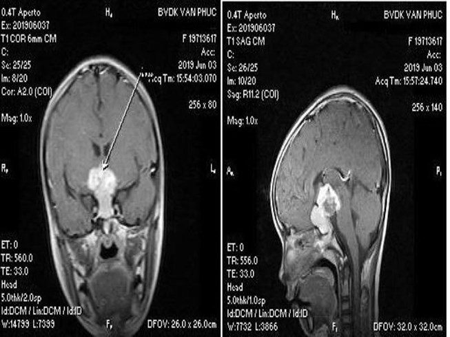 B&eacute; 9 tuổi mắc u n&atilde;o: Những dấu hiệu cảnh b&aacute;o bệnh cha mẹ thường bỏ qua
