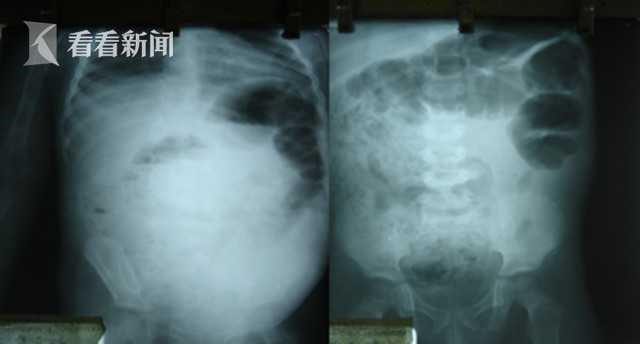 Ổ giun khổng lồ trong bụng b&eacute; trai 4 tuổi: Dấu hiệu nhiễm giun thường bị cha mẹ bỏ qua