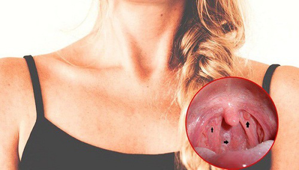 Ung thư thanh quản: 5 dấu hiệu nhiều người thường bỏ qua