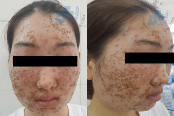 D&ugrave;ng bột rửa mặt mua tr&ecirc;n mạng c&ocirc; g&aacute;i 22 tuổi bị n&oacute;ng r&aacute;t, ngứa to&agrave;n mặt