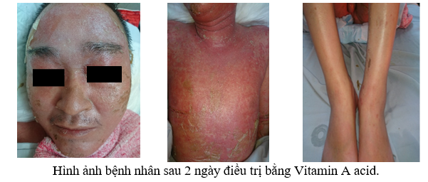 Người đ&agrave;n &ocirc;ng gặp biến chứng v&igrave; sử dụng thuốc nam điều trị vảy nến