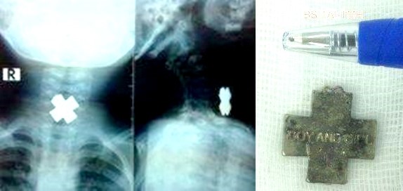 Dị vật được lấy ra từ trong thực quản của b&eacute; An.