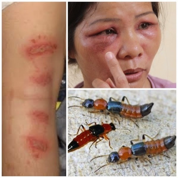 Kiến ba khoang cắn c&oacute; thể bị bỏng r&aacute;t nhiều nơi tr&ecirc;n cơ thể.