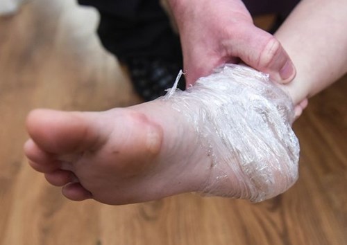  B&eacute; g&aacute;i 7 tuổi su&yacute;t bị thi&ecirc;u sống v&igrave; chăn điện bốc ch&aacute;y. 