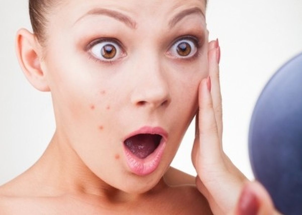 Mụn trứng c&aacute; l&agrave; nỗi &aacute;m ảnh của nhiều người. 