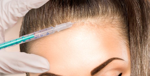 Nguy cơ tử vong v&igrave; ti&ecirc;m botox l&ecirc;n da đầu l&agrave;m đẹo t&oacute;c. Ảnh minh họa