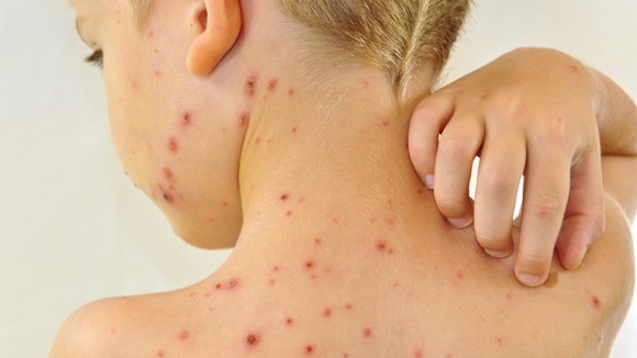 Cảnh b&aacute;o, bệnh thủy đậu vẫn diễn biến phức tạp. Ảnh minh họa 