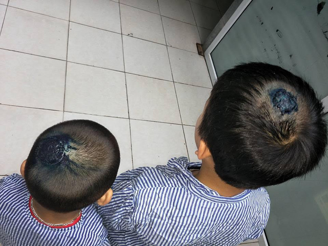 Hai bệnh nhi mắc bệnh hiếm gặp l&agrave; nấm tổ ong tr&ecirc;n đầu do chơi với ch&oacute;, m&egrave;o. Ảnh: D&acirc;n tr&iacute; 