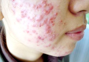  Sử dụng kem chống nắng sai c&aacute;ch c&oacute; nguy cơ mọc đầy mụn. Ảnh minh họa