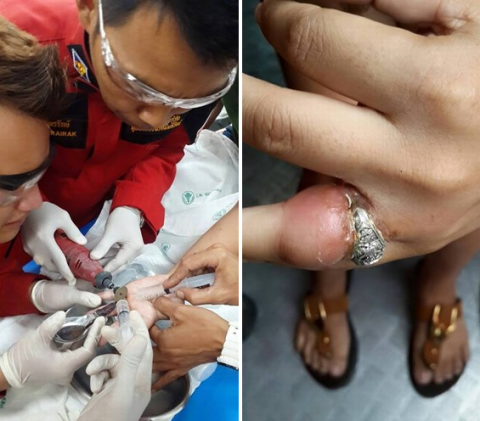 https://baodatviet.vn/ Để lấy chiếc nhẫn ra khỏi tay c&ocirc; g&aacute;i c&aacute;c b&aacute;c sĩ đ&atilde; phải rất vất vả. doi-song/suc-khoe/nguoi-phu-nu-suyt-bi-hoai-tu-vi-deo-nhieu-nhan-chat-3338611/