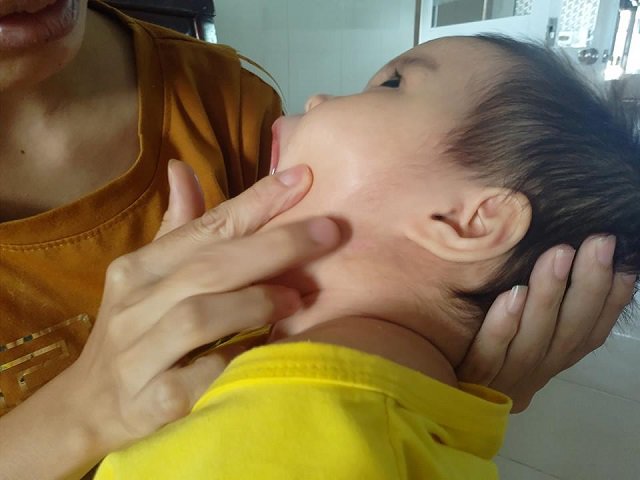 Chỉ v&igrave; vết c&ocirc;n tr&ugrave;ng cắn m&agrave; b&eacute; Bảo An hiện kh&ocirc;ng c&ograve;n nhận thức như trước. Ảnh: Kh&aacute;m ph&aacute;