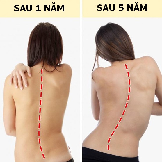  Nếu bạn lười vận động nhưng cứ ngồi &igrave; một chỗ cả ng&agrave;y th&igrave; cột sống của bạn sẽ vẹo như h&igrave;nh ảnh n&agrave;y. Ảnh: D&acirc;n tr&iacute;