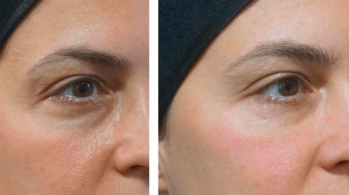  Tiêm chất làm đầy không đảm bảo sẽ có nguy cơ biến chứng cao. Ảnh minh họa