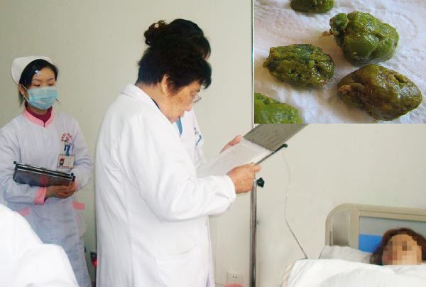 H&igrave;nh ảnh những vi&ecirc;n sỏi đ&atilde; được lấy ra từ t&uacute;i mật của c&ocirc; g&aacute;i chỉ v&igrave; ăn chay để giảm c&acirc;n.  