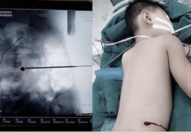  H&igrave;nh ảnh b&eacute; trai điều trị tại bệnh viện. Ảnh: D&acirc;n tr&iacute;
