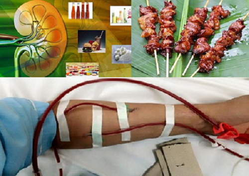  Nguy cơ suy thận, chạy thận cả đời v&igrave; lạm dụng nhiều nước sốt, đồ chi&ecirc;n r&aacute;n, thuốc giảm đau