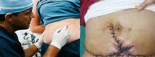  H&uacute;t mỡ bụng c&oacute; nguy cơ xảy ra nhiều biến chứng nguy hiểm