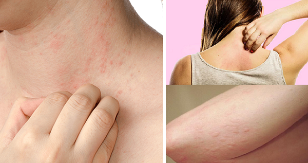 Ngứa da l&agrave; dấu hiệu của nhiều bệnh nguy hiểm cần kh&aacute;m ngay
