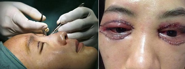  L&agrave;m đẹp mắt trong dịp Tết tại nơi kh&ocirc;ng uy t&iacute;n dễ biến chứng nguy hiểm