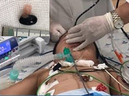  H&oacute;c hạt m&atilde;ng cầu b&eacute; trai 3 tuổi bị ngưng tim, nguy kịch. 