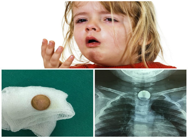 H&igrave;nh ảnh chiếc đồng cu chặn ngang cổ họng b&eacute; K. 