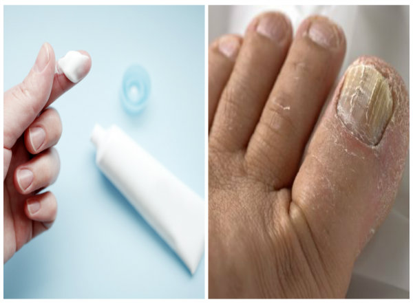  Thận trọng khi dùng thuốc chống nấm ketoconazol kéo dài