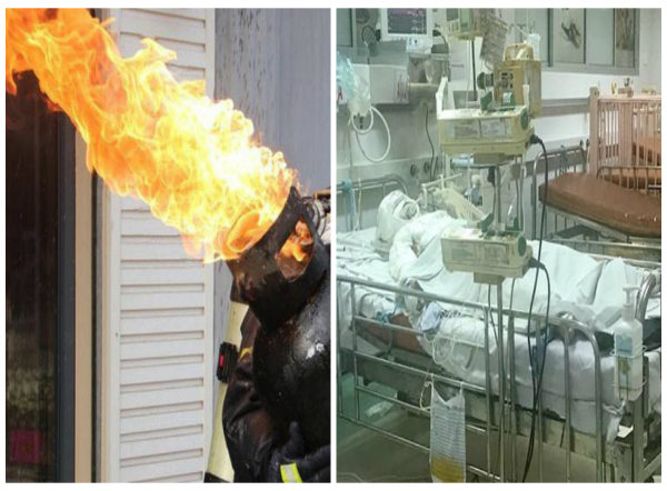  Bố h&uacute;t thuốc trong nh&agrave; khiến b&igrave;nh gas ph&aacute;t nổ l&agrave;m hai bố con bỏng nặng