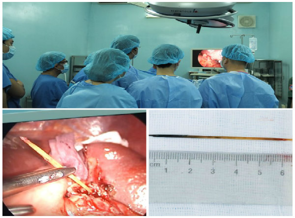  Ngậm tăm khi ngủ nuốt v&agrave;o bụng g&acirc;y thủng ruột, thủng l&aacute; l&aacute;ch