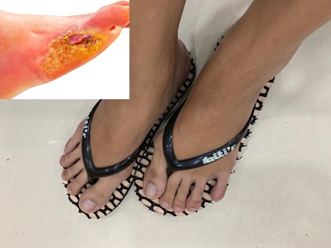 Người mắc bệnh tiểu đường kh&ocirc;ng n&ecirc;n đi d&eacute;p xỏ ng&oacute;n v&igrave; c&oacute; thể gặp biến chứng 