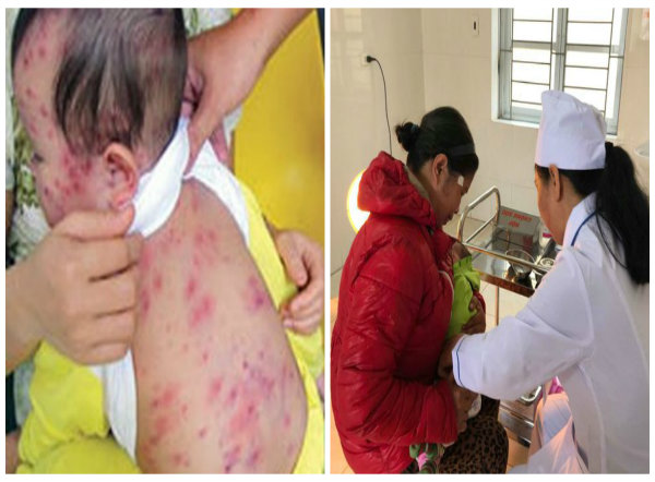 Trẻ nhập viện tăng cao so mắc sởi v&igrave; kh&ocirc;ng ti&ecirc;m ph&ograve;ng văcxin 