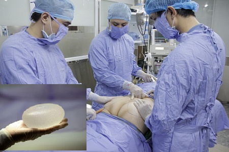 N&acirc;ng m&ocirc;ng thẩm mỹ c&oacute; thể bị ung thư 