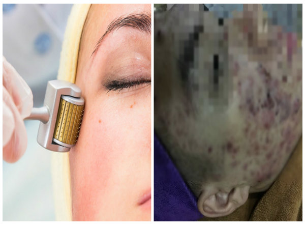 Lăn kim trị mụn biến chứng kh&oacute; lường n&ecirc;n thận trọng 