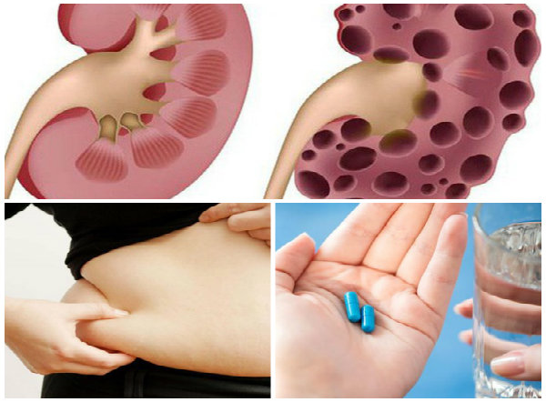 Kh&aacute; nhiều người bị suy thận v&igrave; uống thuốc giảm c&acirc;n thần tốc 