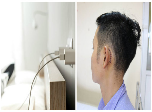  Điện thoại ph&aacute;t nổ khi đang sạc khiến ch&agrave;ng trai bị r&aacute;ch tai