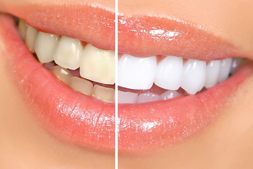 L&agrave;m trắng răng bằng c&aacute;c sản phẩm như bột, miếng d&aacute;n cần thận trọng 