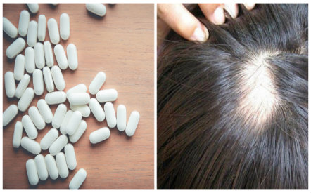Sử dụng thuốc chữa rụng t&oacute;c finasterid c&oacute; nguy cơ xuất hiện h&agrave;nh vi tự tử