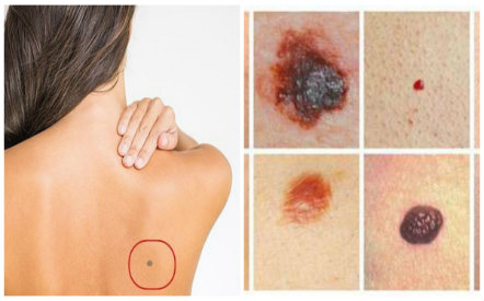  Ung thư từ nốt ruồi vô cùng nguy hiểm vì dẫn đến cái chết rất nhanh