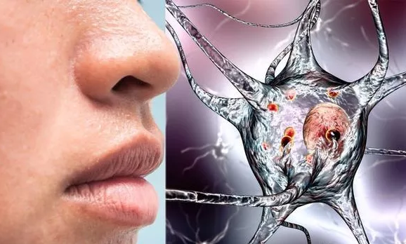  Mất m&ugrave;i l&agrave; dấu hiệu cảnh b&aacute;o sớm bệnh Parkinson. Ảnh: express