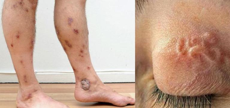 dễ bị gian s&aacute;n, vi&ecirc;m lo&eacute;t tay ch&acirc;n