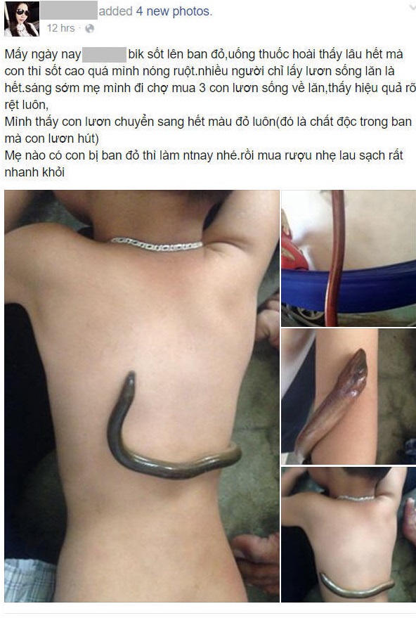Sự thật về c&aacute;ch hạ sốt bằng lươn sống