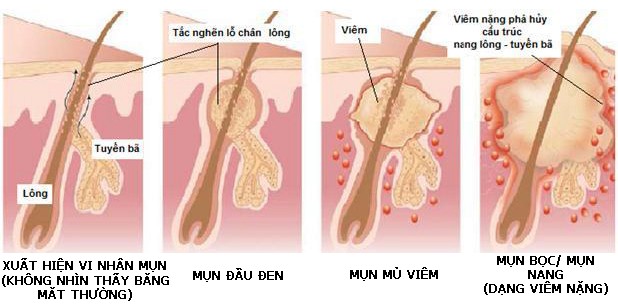 Thuốc trị mụn v&agrave; phương ph&aacute;p điều trị tại nh&agrave; sẽ hiệu quả hơn khi bạn nắm được cơ chế của mụn trứng c&aacute;
