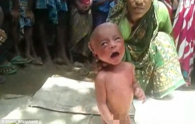 Trẻ sơ sinh bị &eacute;p b&ecirc;u nắng để chữa bệnh